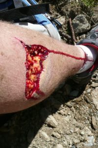 Krwotok z rany szarpanej nogi